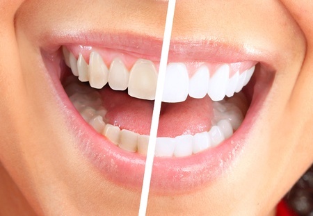 Dental Veneers in Birmingham, MI Solve a Variety of Cosmetic Issues
