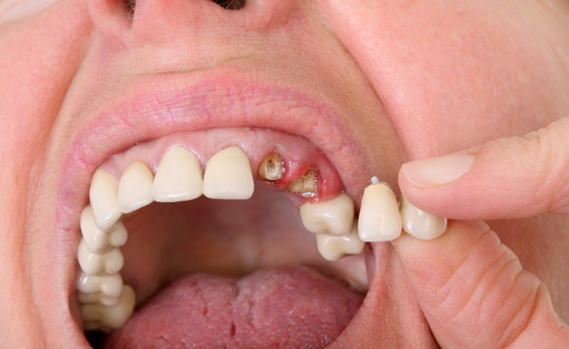 Details About Dental Filling In Indianapolis, IN