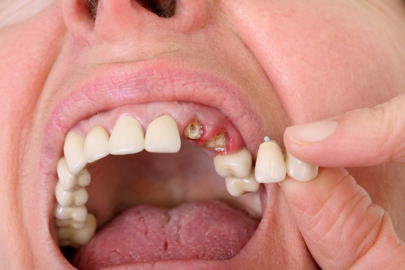 Details About Dental Filling In Indianapolis, IN