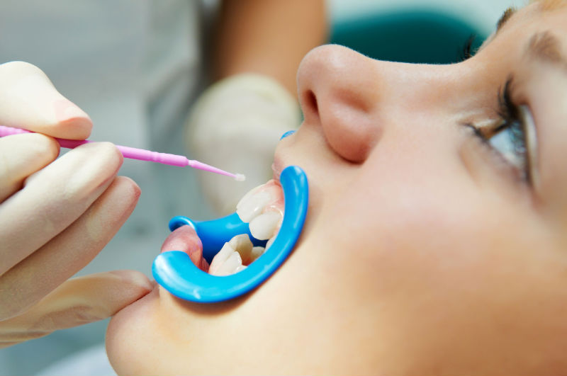 It’s Imperative to Find Skilled Implant Dentistry Services in Vancouver, WA