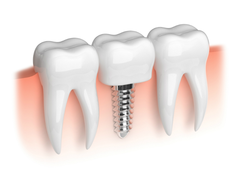 Benefits That You Can Reap From Getting Dental Implants in Southampton