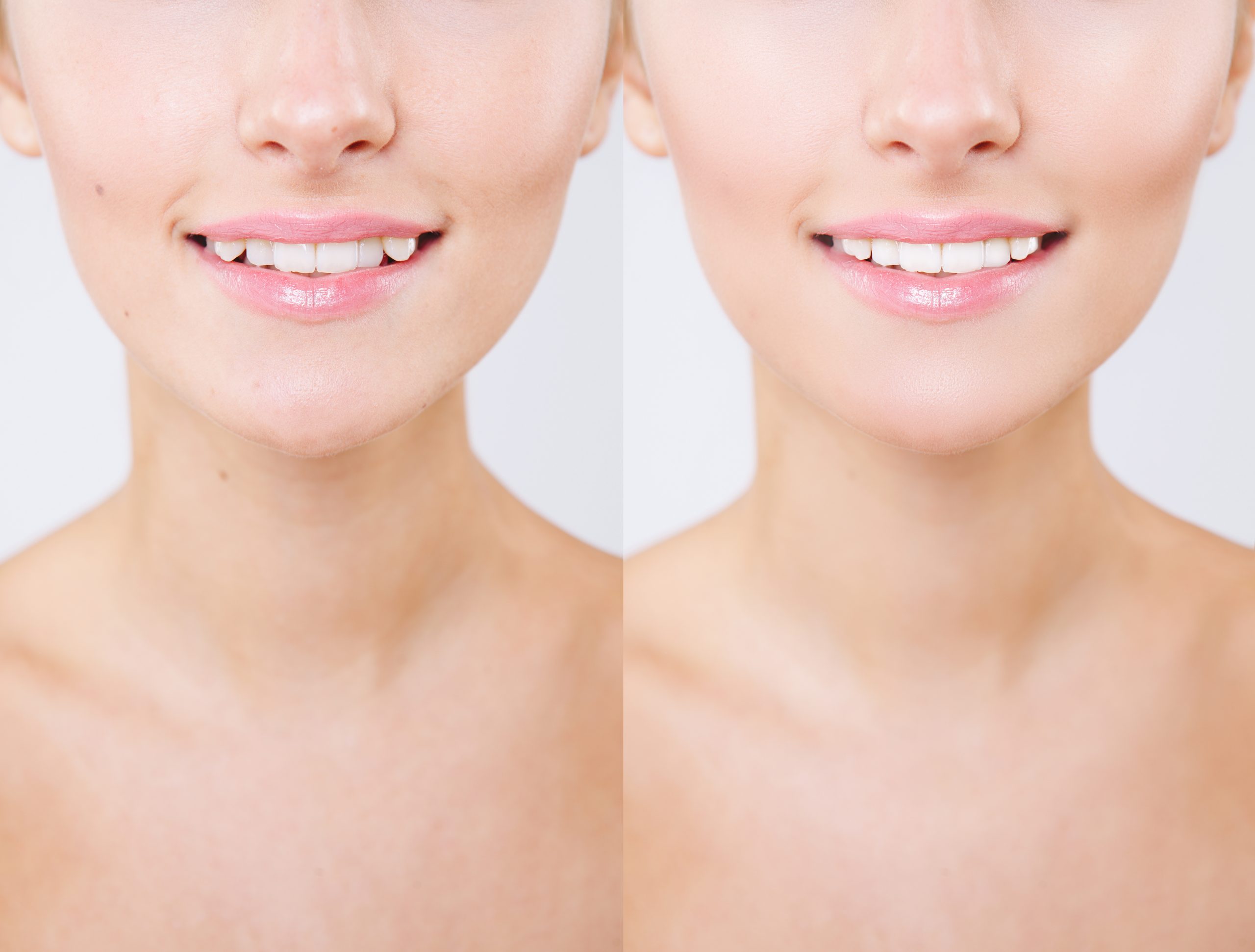 Reasons Why You Might Need Dental Crowns in Charlotte, North Carolina