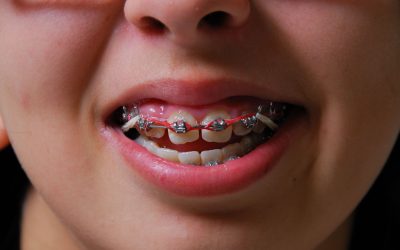 Undergoing Skilled Orthodontics For Adults In Medina OH To Straighten Your Teeth
